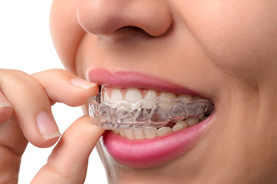 invisalign North Miami